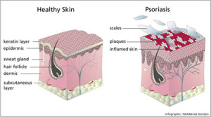 psoriasis_schematic