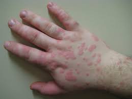 patch test for allergy